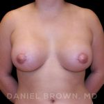 Breast Lift & Implant Before & After Patient #9687