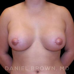 Breast Lift & Implant Before & After Patient #9687