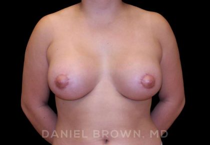 Breast Lift & Implant Before & After Patient #9687