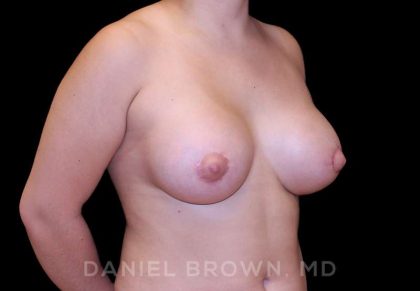 Breast Lift & Implant Before & After Patient #9687