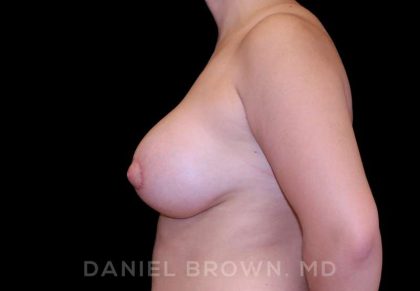 Breast Lift & Implant Before & After Patient #9687