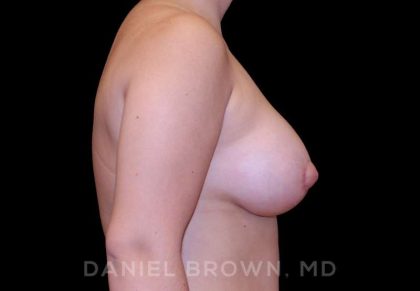 Breast Lift & Implant Before & After Patient #9687