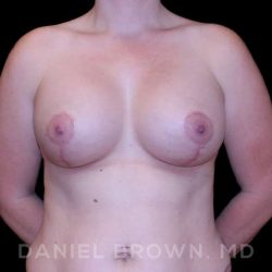 Breast Lift & Implant Before & After Patient #9698