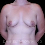 Breast Lift & Implant Before & After Patient #9698