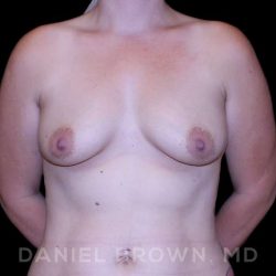 Breast Lift & Implant Before & After Patient #9698