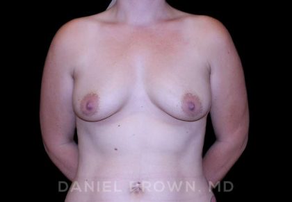 Breast Lift & Implant Before & After Patient #9698