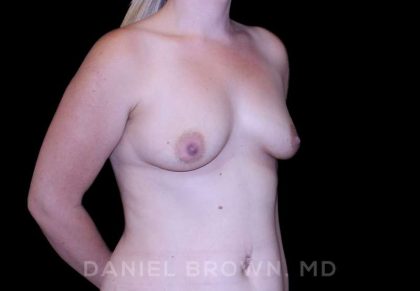 Breast Lift & Implant Before & After Patient #9698