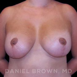Breast Lift & Implant Before & After Patient #9709