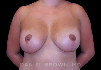 Breast Lift & Implant Before & After Patient #9709