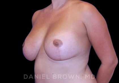 Breast Lift & Implant Before & After Patient #9709