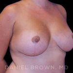 Breast Lift & Implant Before & After Patient #9709