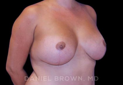 Breast Lift & Implant Before & After Patient #9709