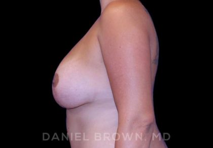 Breast Lift & Implant Before & After Patient #9709