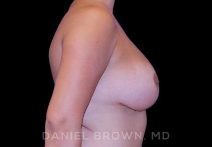 Breast Lift & Implant Before & After Patient #9709