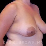 Breast Lift & Implant Before & After Patient #9709