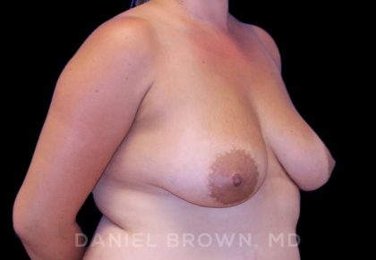 Breast Lift & Implant Before & After Patient #9709