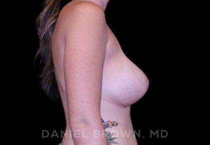 Breast Lift & Implant Before & After Patient #9720