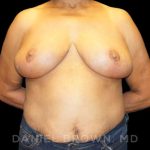 Breast Reduction Before & After Patient #9727