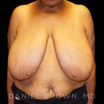 Breast Reduction Before & After Patient #9727