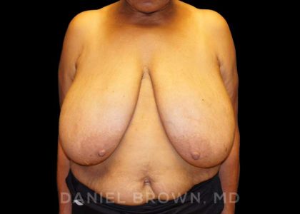 Breast Reduction Before & After Patient #9727