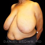 Breast Reduction Before & After Patient #9727