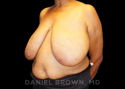 Breast Reduction Before & After Patient #9727