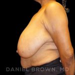 Breast Reduction Before & After Patient #9727