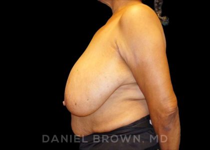 Breast Reduction Before & After Patient #9727