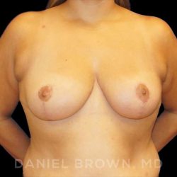 Breast Reduction Before & After Patient #9734
