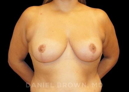 Breast Reduction Before & After Patient #9734