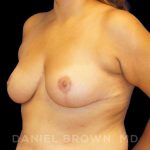 Breast Reduction Before & After Patient #9734