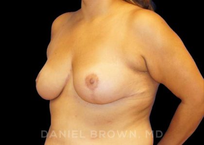 Breast Reduction Before & After Patient #9734