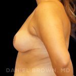 Breast Reduction Before & After Patient #9734