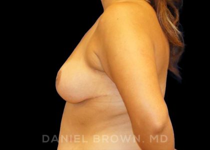 Breast Reduction Before & After Patient #9734
