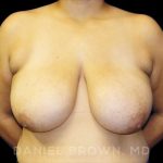 Breast Reduction Before & After Patient #9734
