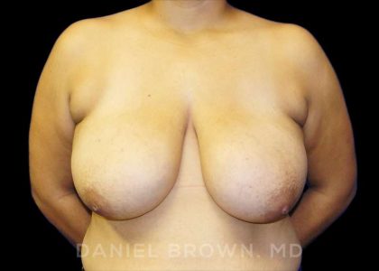 Breast Reduction Before & After Patient #9734