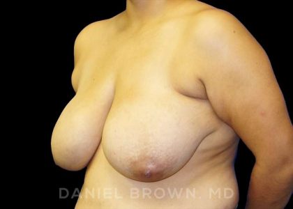 Breast Reduction Before & After Patient #9734