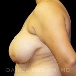 Breast Reduction Before & After Patient #9734