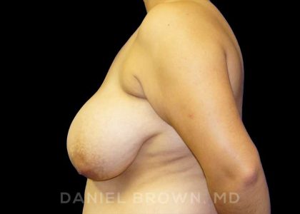 Breast Reduction Before & After Patient #9734
