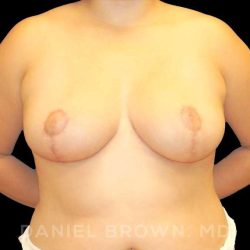 Breast Reduction Before & After Patient #9756