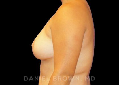 Breast Reduction Before & After Patient #9756