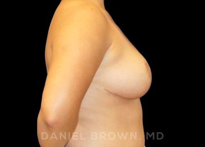 Breast Reduction Before & After Patient #9756
