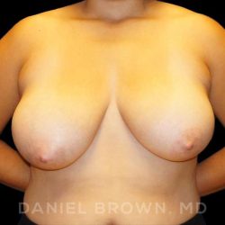 Breast Reduction Before & After Patient #9756