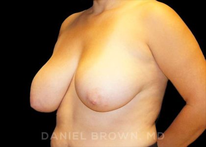 Breast Reduction Before & After Patient #9756