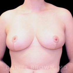 Breast Reduction Before & After Patient #9763