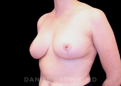 Breast Reduction Before & After Patient #9763