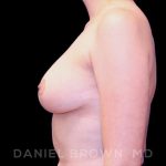 Breast Reduction Before & After Patient #9763