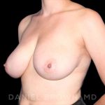 Breast Reduction Before & After Patient #9763