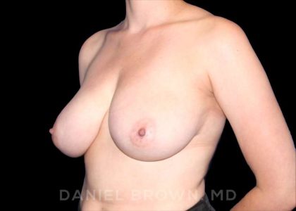 Breast Reduction Before & After Patient #9763