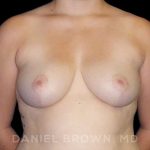 Breast Reduction Before & After Patient #9774